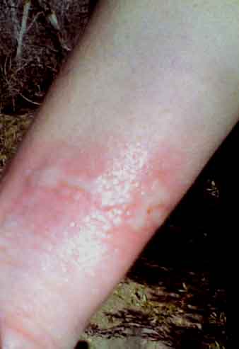 Welts from stinging nettle